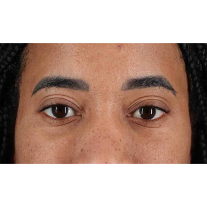 Eyelid Surgery Before & After Patient #1946