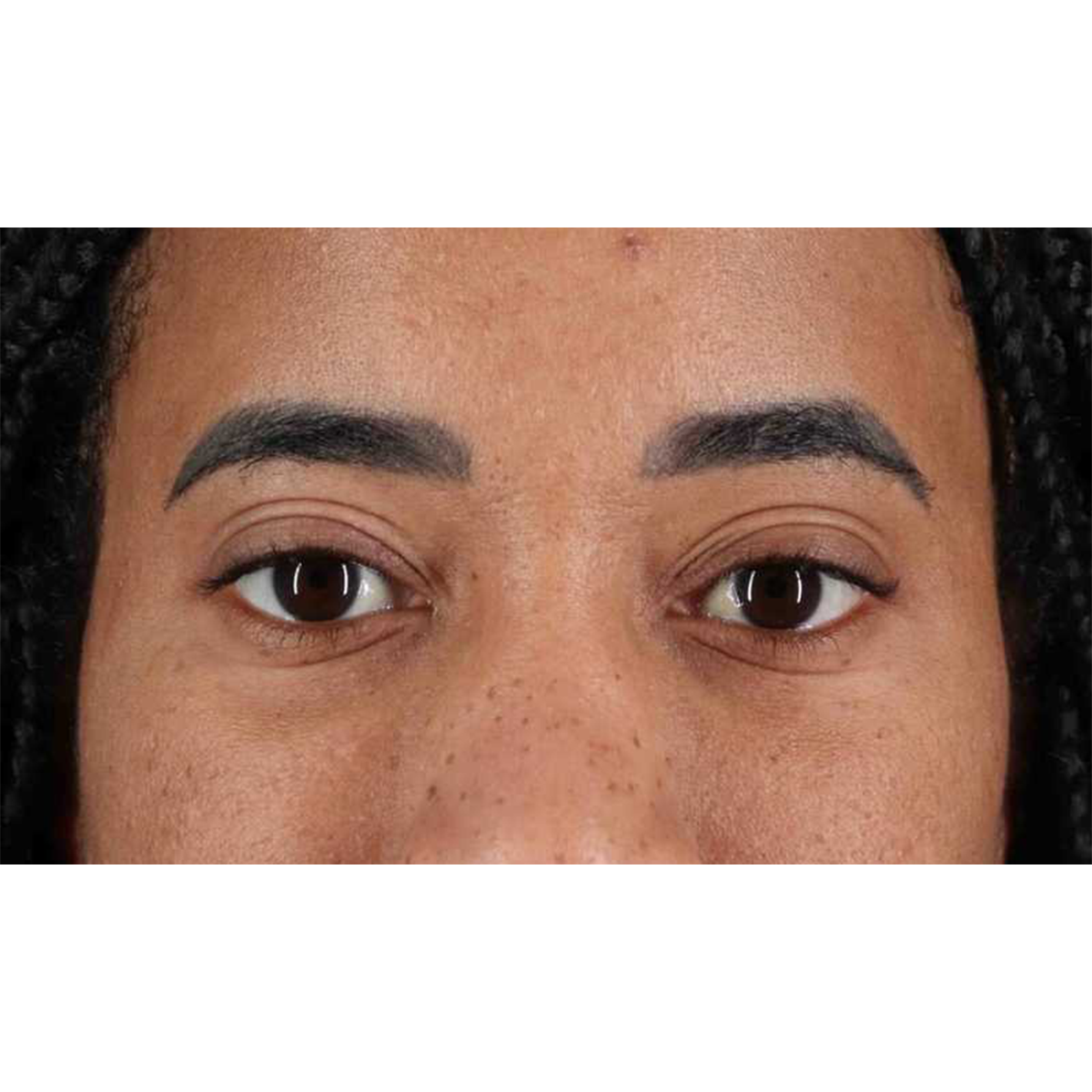 Eyelid Surgery Before & After Patient #1946