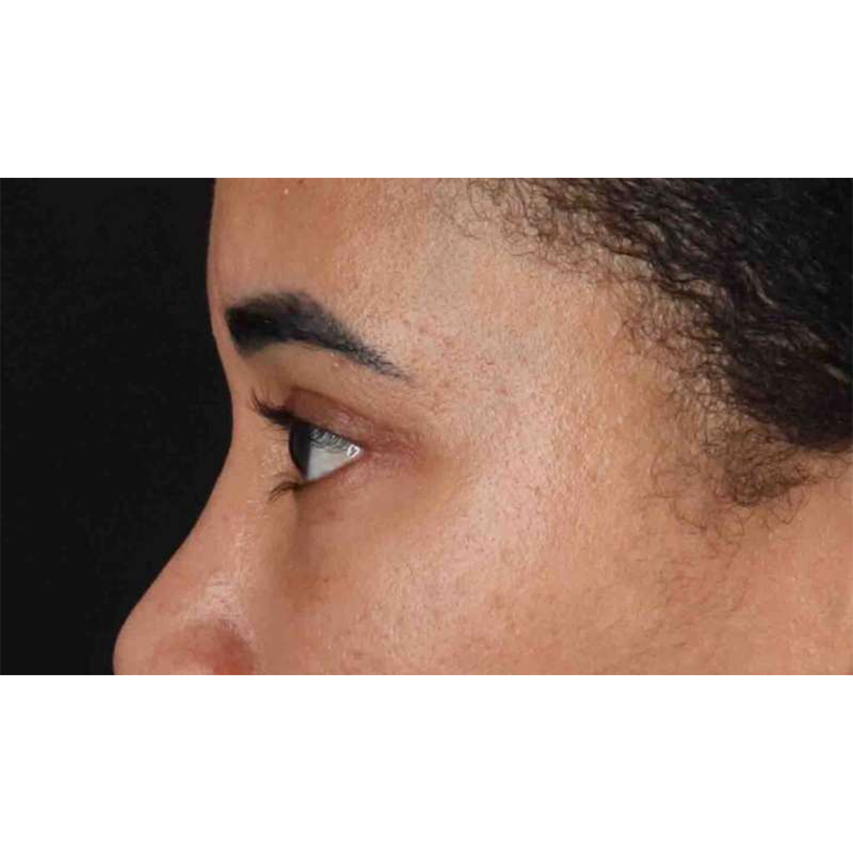 Eyelid Surgery Before & After Patient #1946