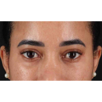 Eyelid Surgery Before & After Patient #1946