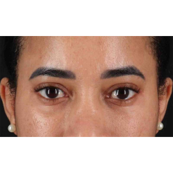 Eyelid Surgery Before & After Patient #1946