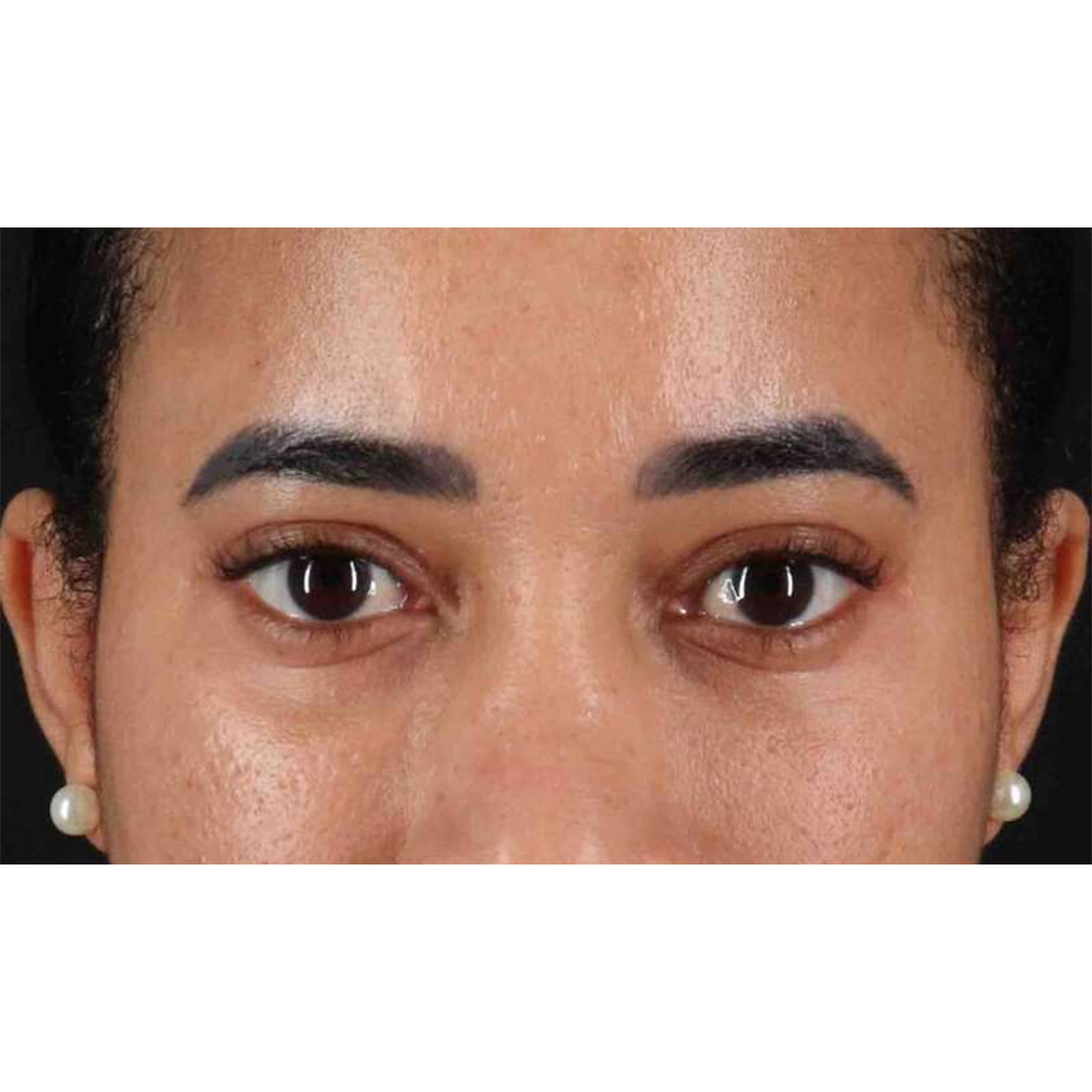 Eyelid Surgery Before & After Patient #1946