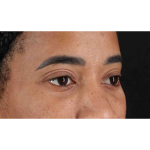 Eyelid Surgery Before & After Patient #1946