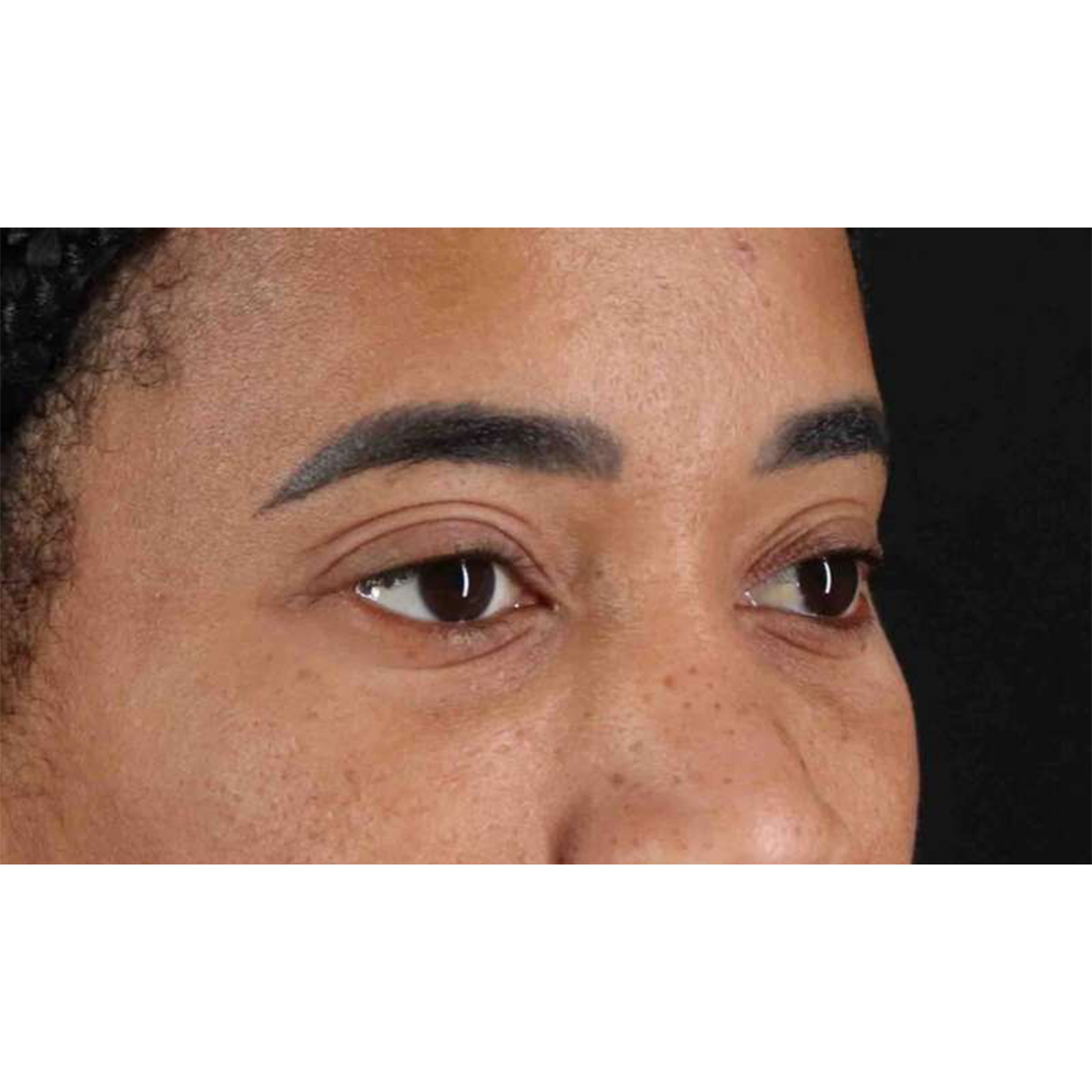 Eyelid Surgery Before & After Patient #1946