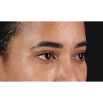 Eyelid Surgery Before & After Patient #1946