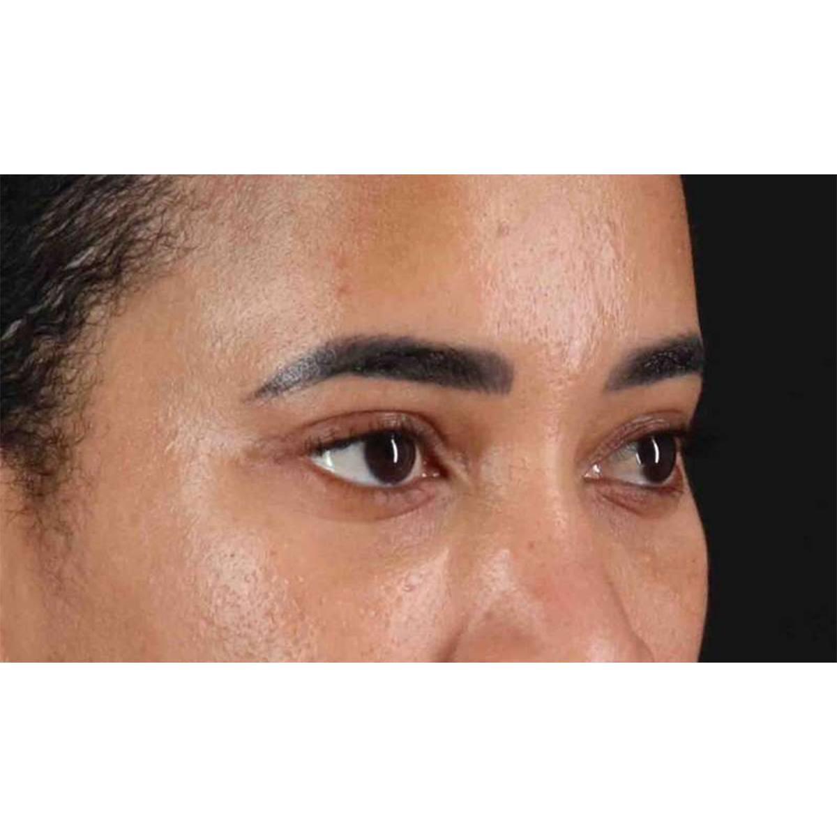 Eyelid Surgery Before & After Patient #1946