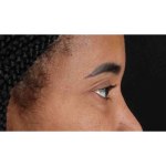 Eyelid Surgery Before & After Patient #1946