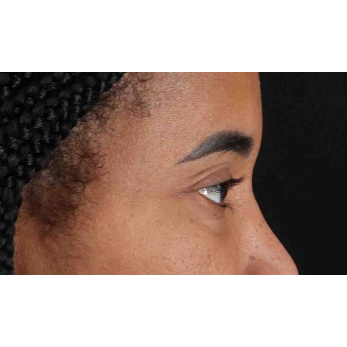 Eyelid Surgery Before & After Patient #1946