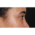Eyelid Surgery Before & After Patient #1946