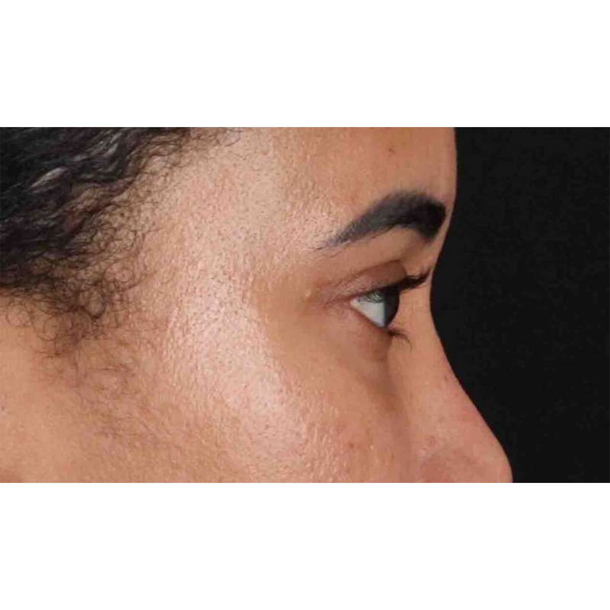 Eyelid Surgery Before & After Patient #1946