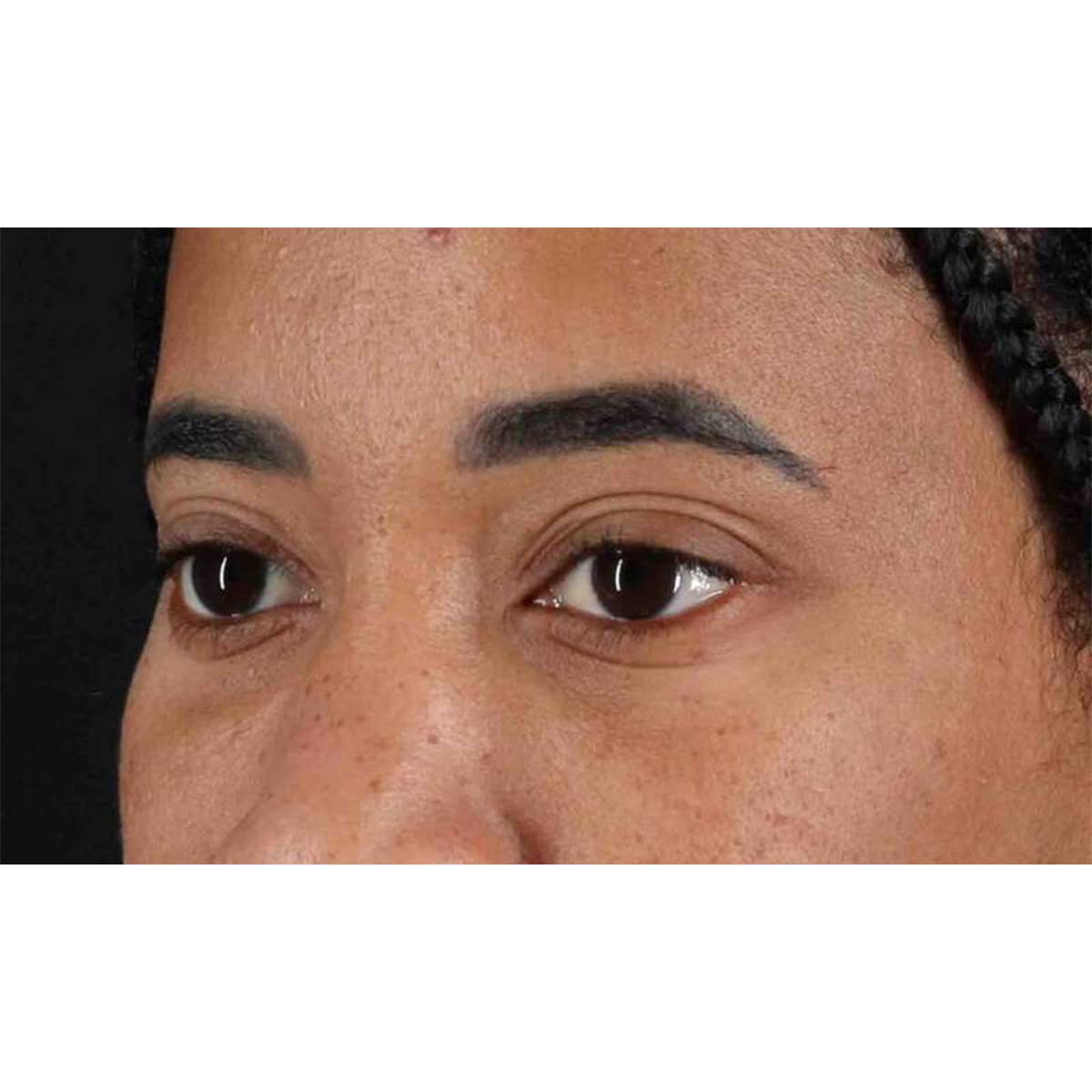 Eyelid Surgery Before & After Patient #1946