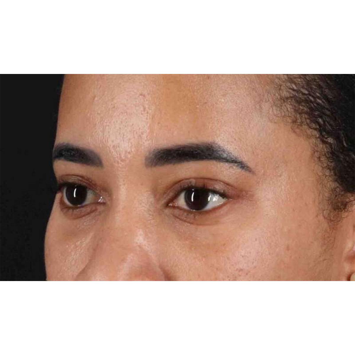 Eyelid Surgery Before & After Patient #1946