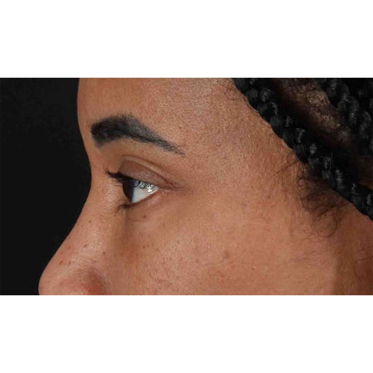 Eyelid Surgery Before & After Patient #1946