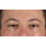 Eyelid Surgery Before & After Patient #1957