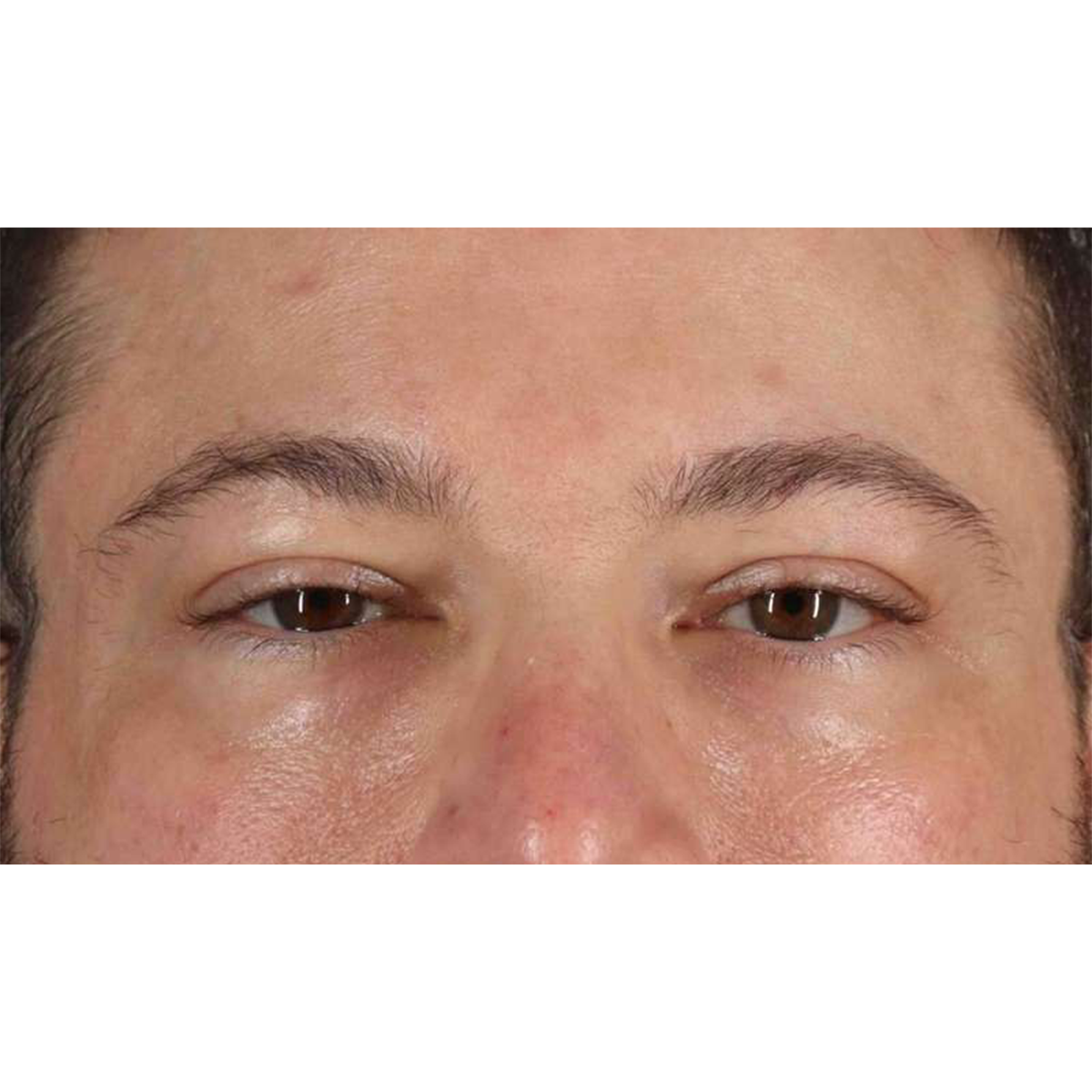 Eyelid Surgery Before & After Patient #1957