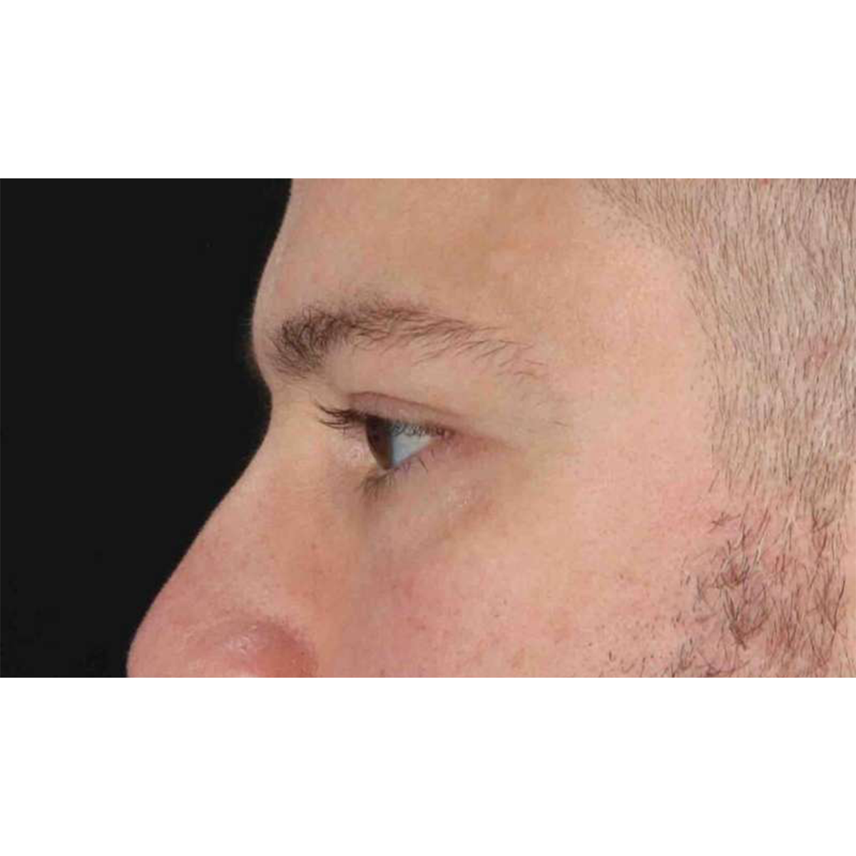 Eyelid Surgery Before & After Patient #1957
