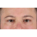 Eyelid Surgery Before & After Patient #1957