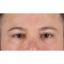 Eyelid Surgery Before & After Patient #1957