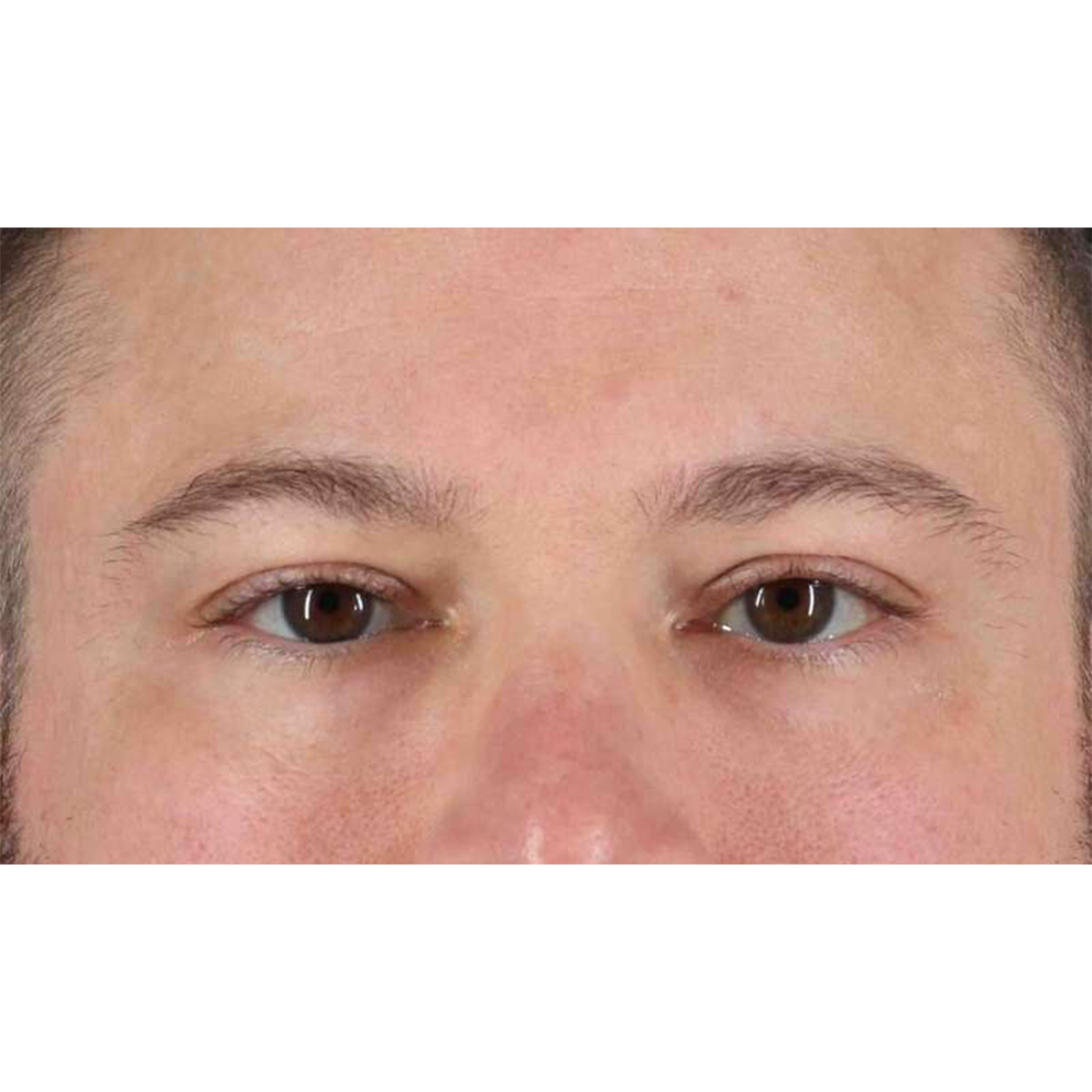 Eyelid Surgery Before & After Patient #1957