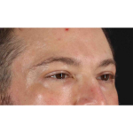 Eyelid Surgery Before & After Patient #1957