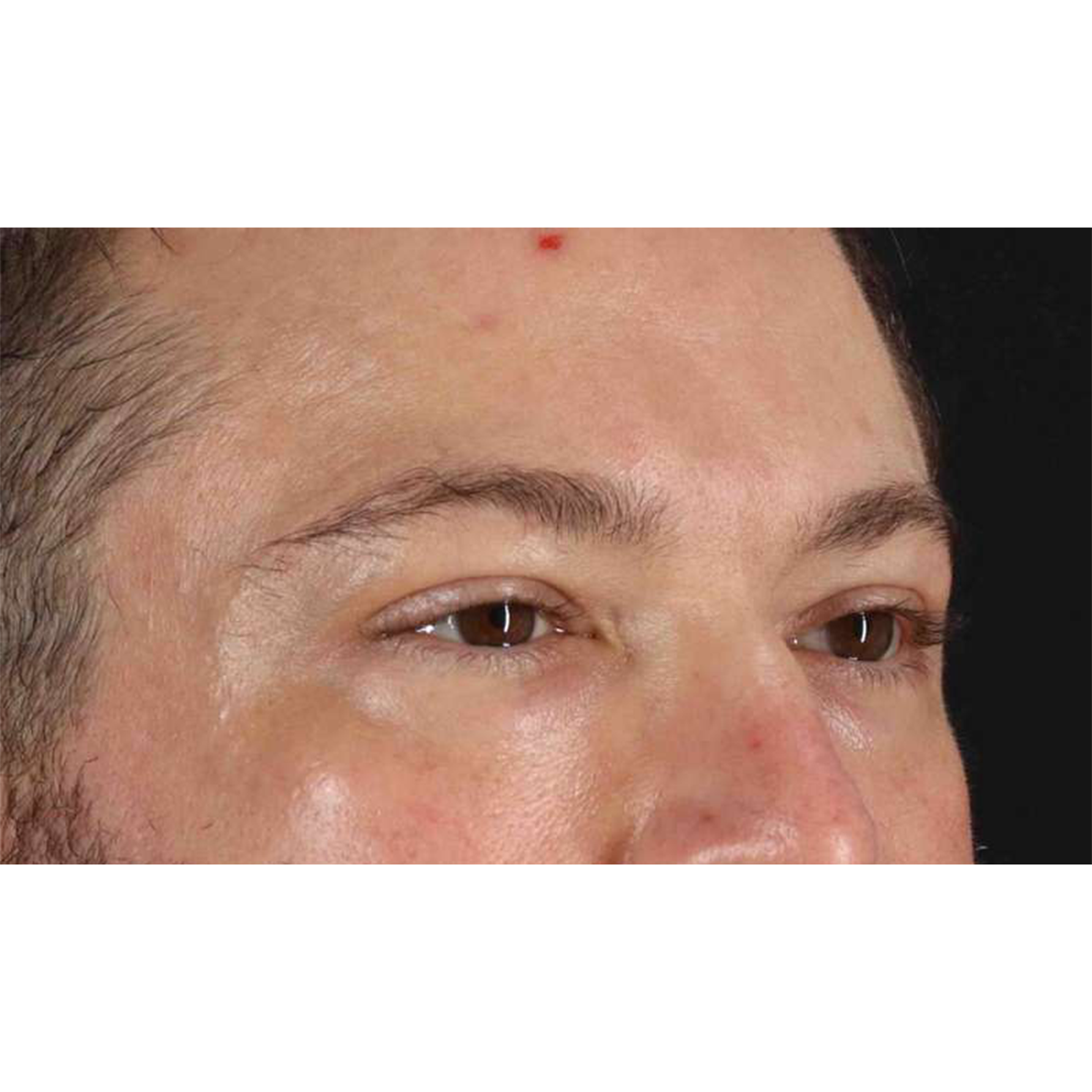 Eyelid Surgery Before & After Patient #1957
