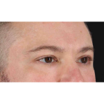 Eyelid Surgery Before & After Patient #1957