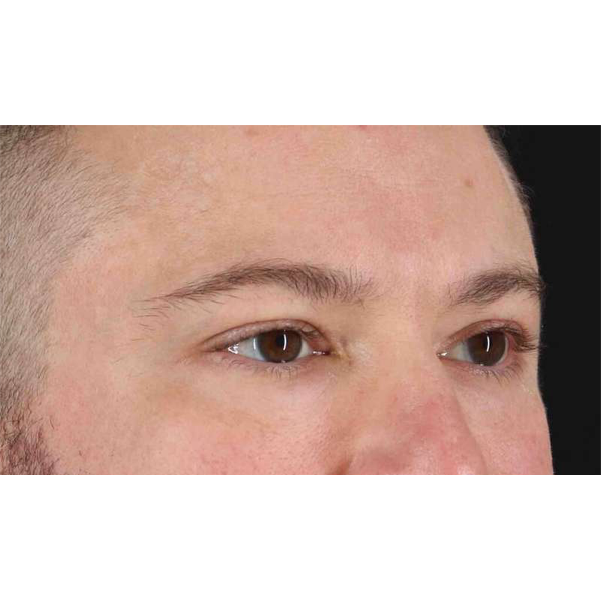 Eyelid Surgery Before & After Patient #1957