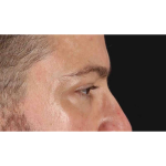 Eyelid Surgery Before & After Patient #1957