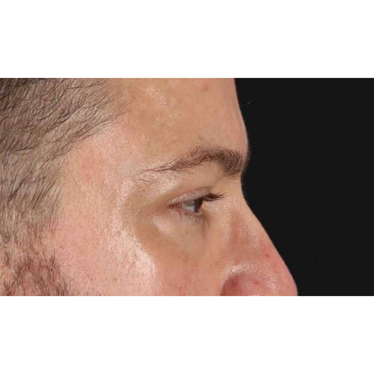 Eyelid Surgery Before & After Patient #1957