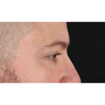 Eyelid Surgery Before & After Patient #1957