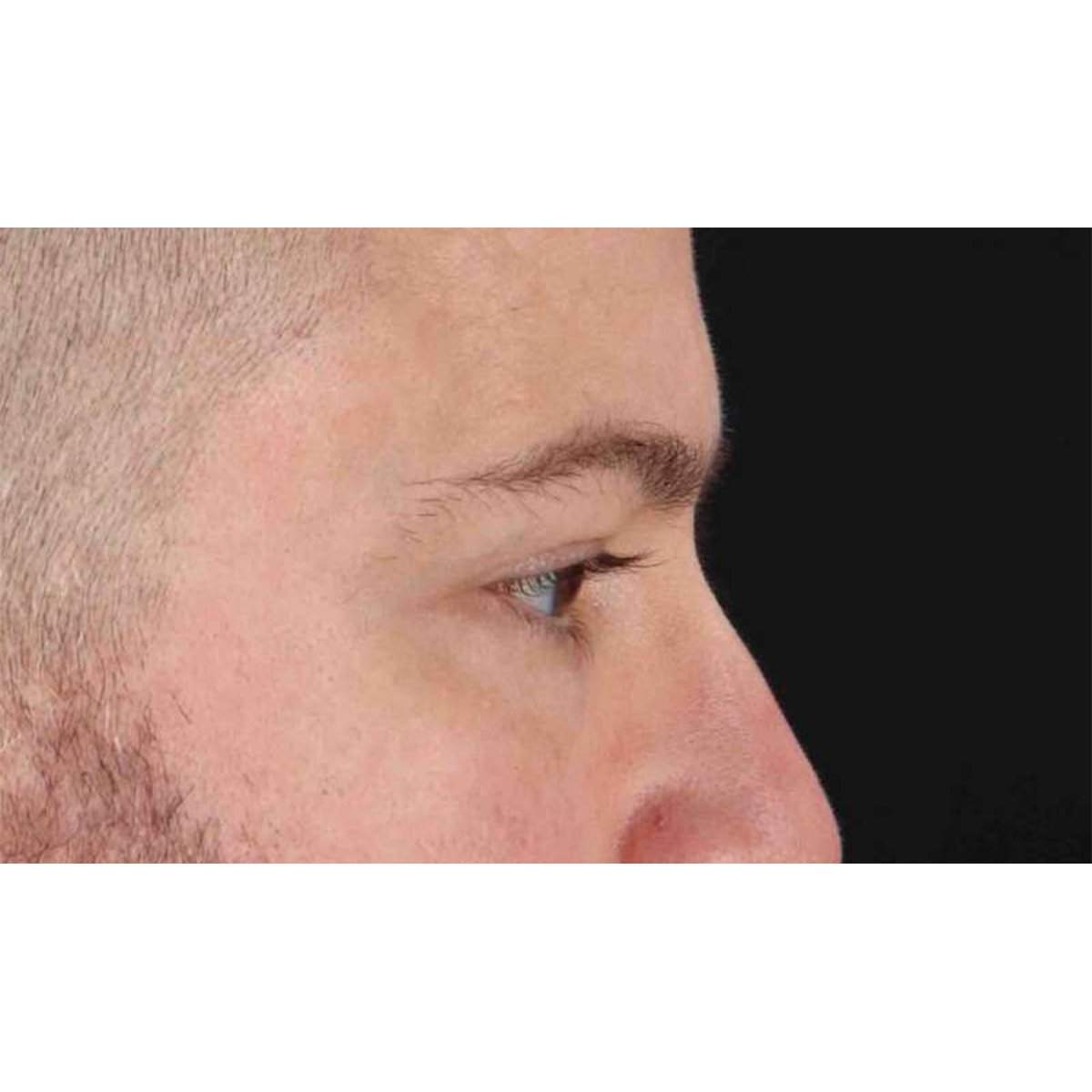 Eyelid Surgery Before & After Patient #1957