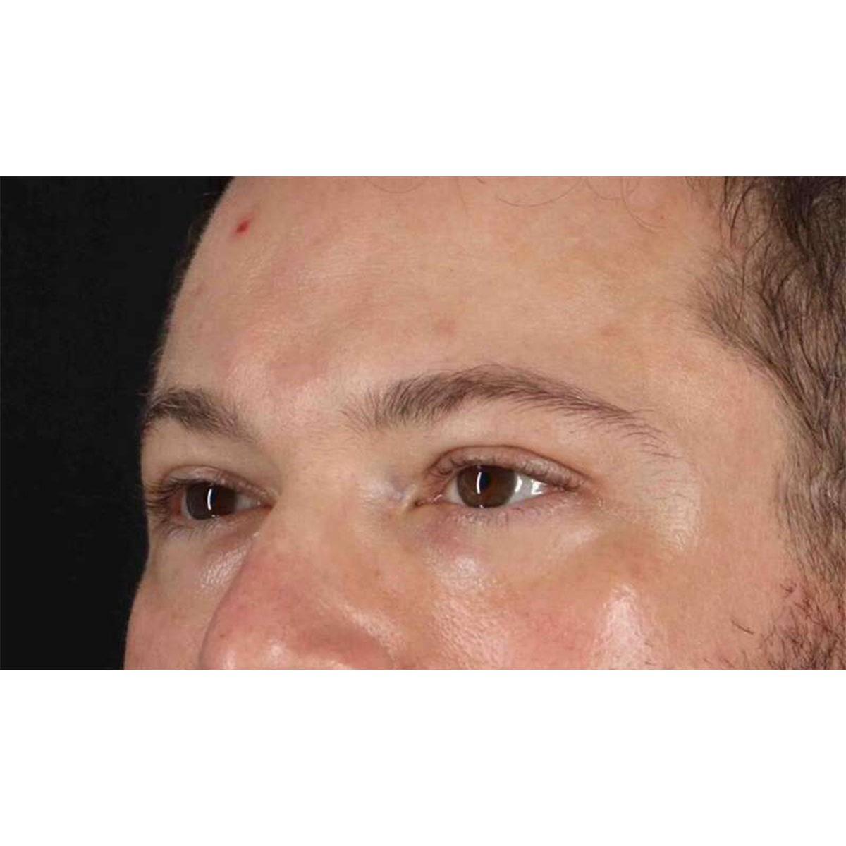 Eyelid Surgery Before & After Patient #1957