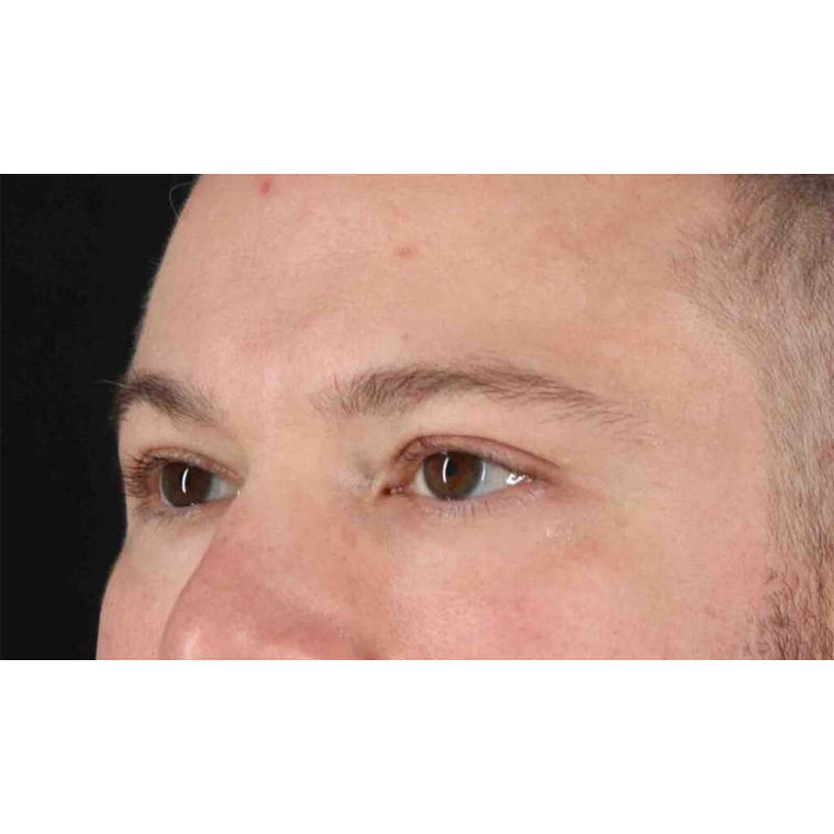 Eyelid Surgery Before & After Patient #1957