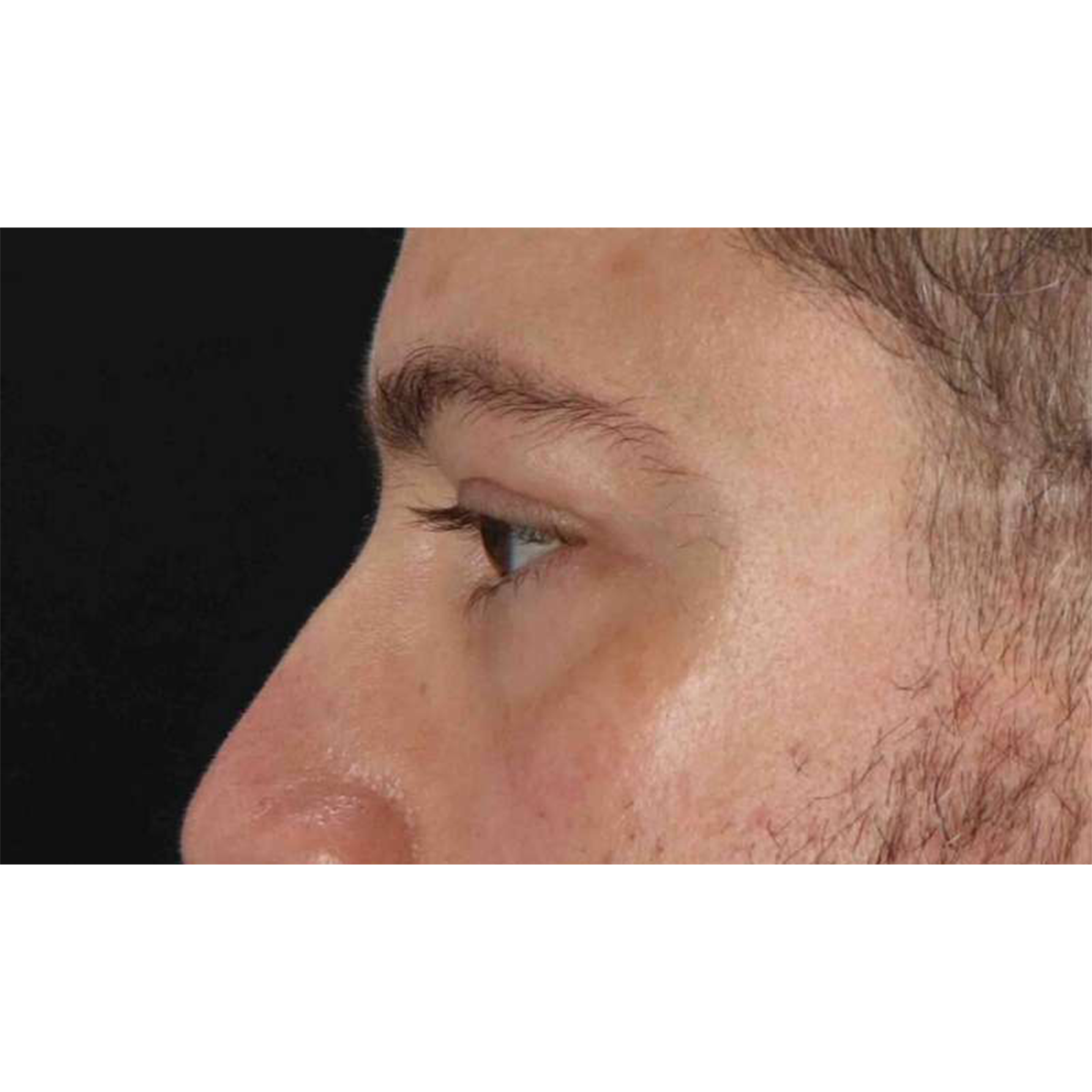 Eyelid Surgery Before & After Patient #1957