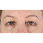 Eyelid Surgery Before & After Patient #1968