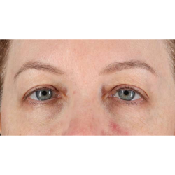 Eyelid Surgery Before & After Patient #1968