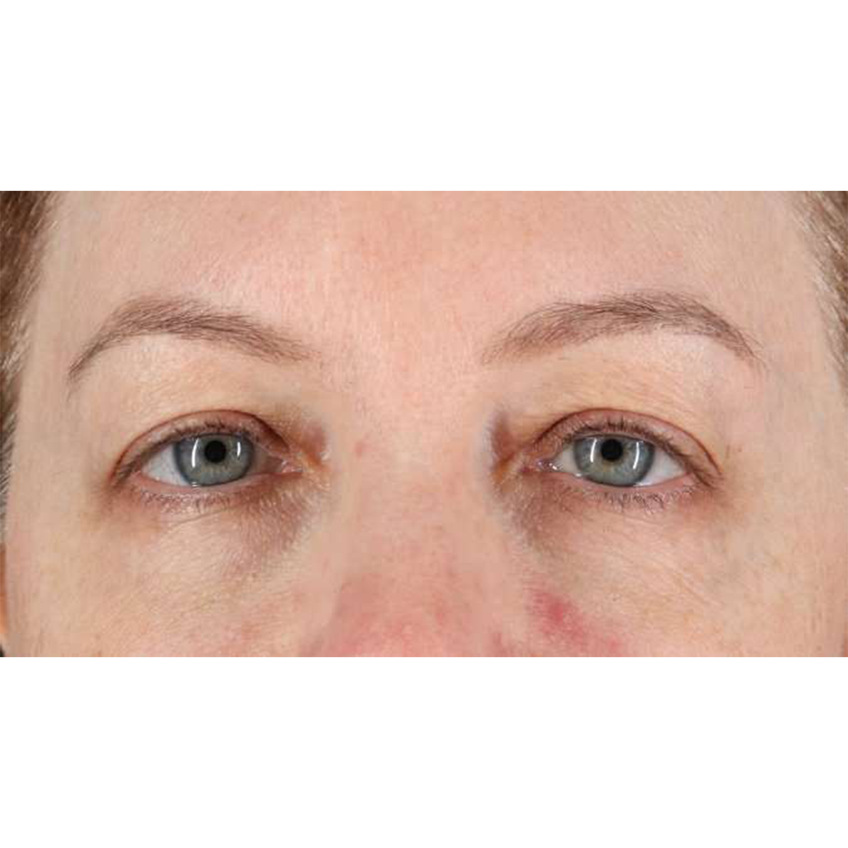 Eyelid Surgery Before & After Patient #1968