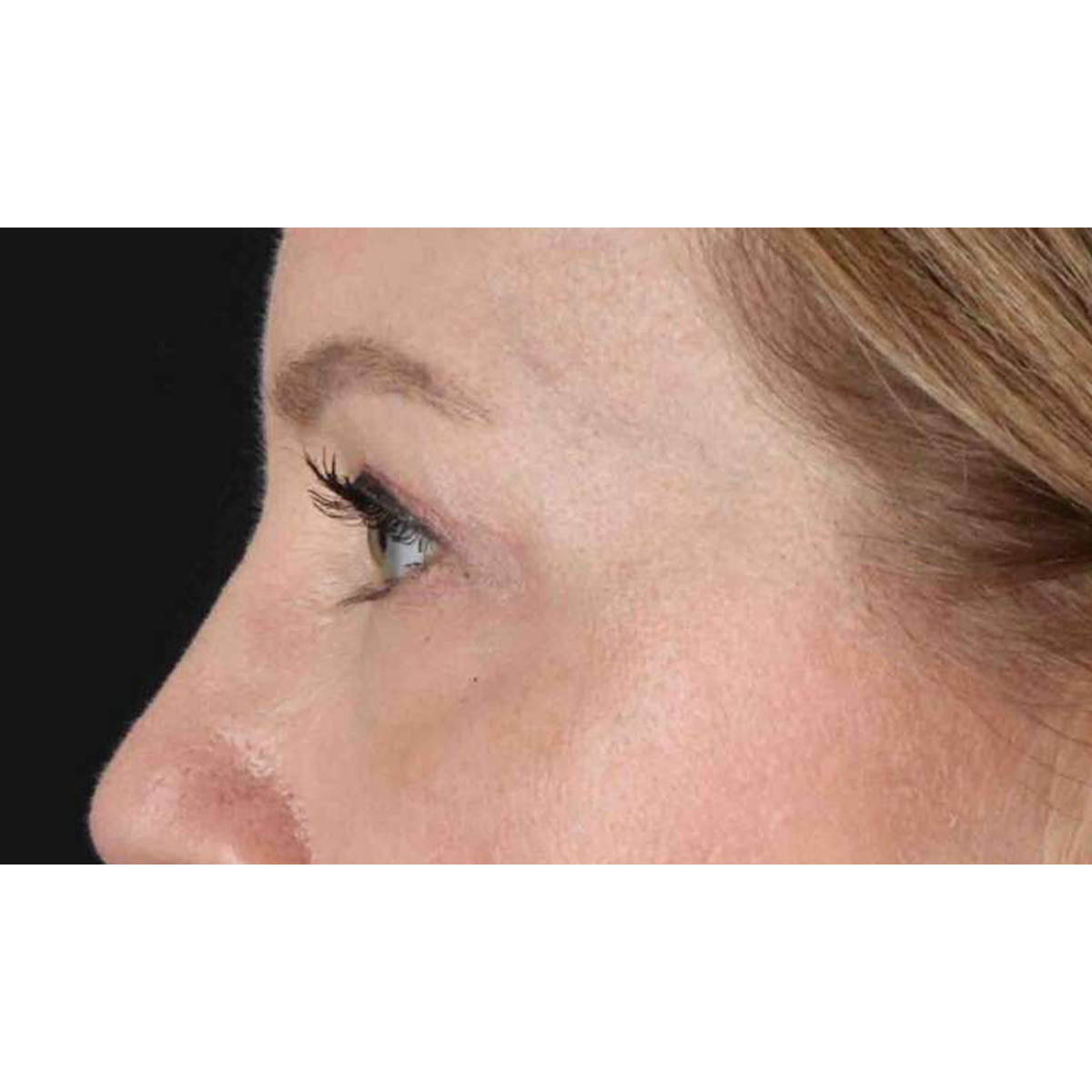 Eyelid Surgery Before & After Patient #1968