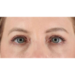 Eyelid Surgery Before & After Patient #1968