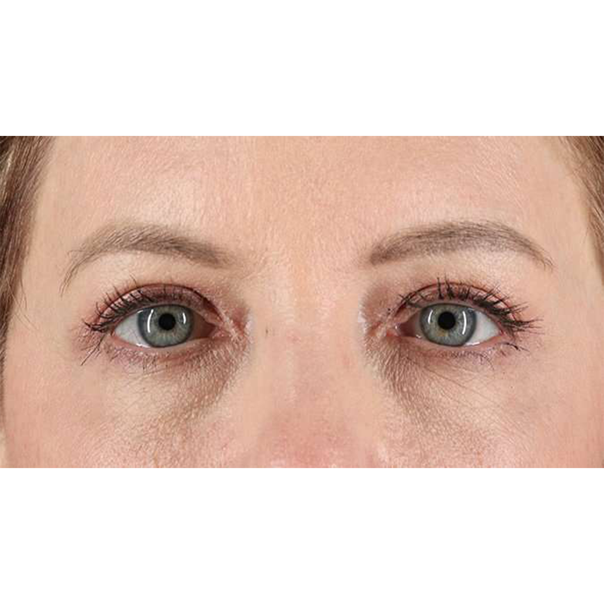 Eyelid Surgery Before & After Patient #1968