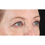 Eyelid Surgery Before & After Patient #1968