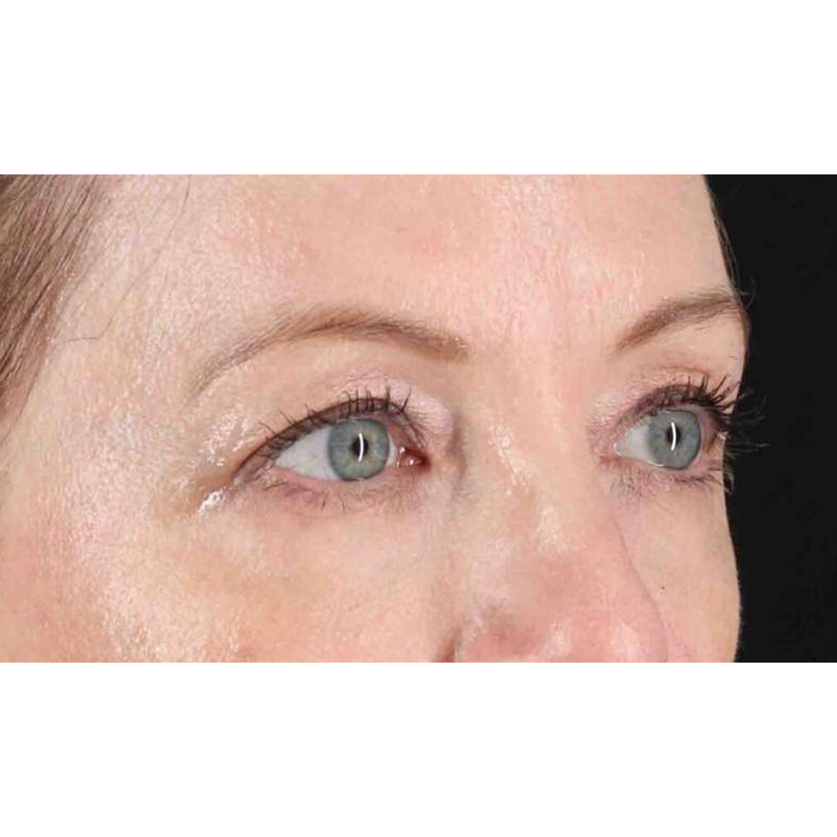 Eyelid Surgery Before & After Patient #1968