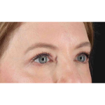 Eyelid Surgery Before & After Patient #1968