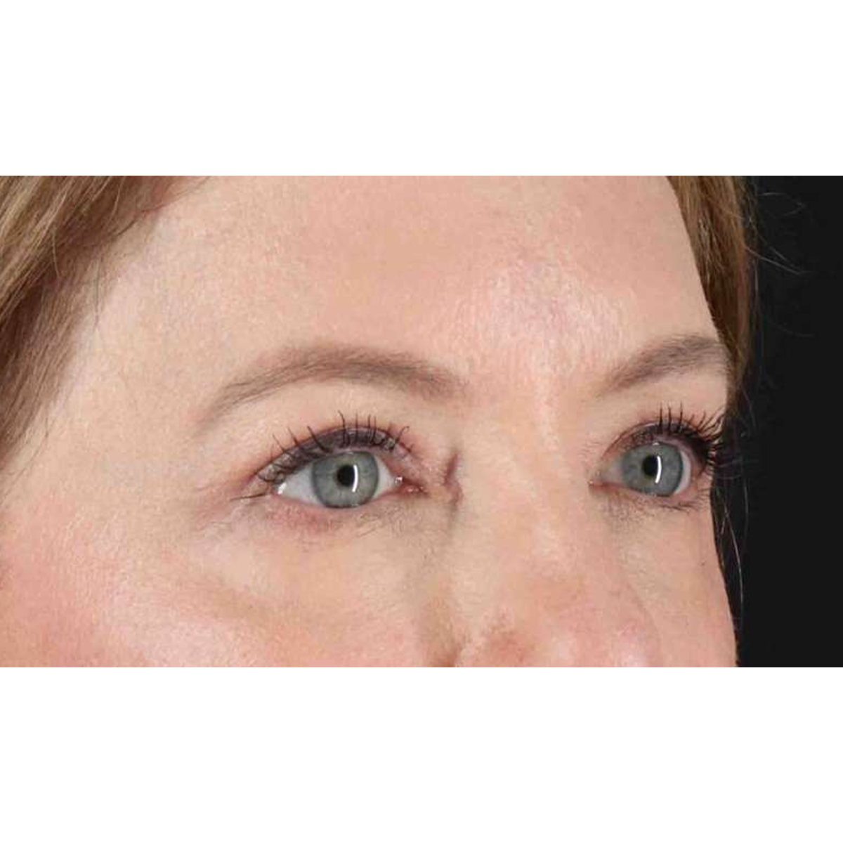 Eyelid Surgery Before & After Patient #1968