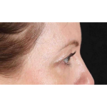 Eyelid Surgery Before & After Patient #1968