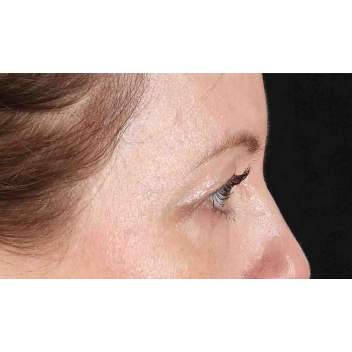 Eyelid Surgery Before & After Patient #1968