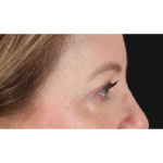 Eyelid Surgery Before & After Patient #1968