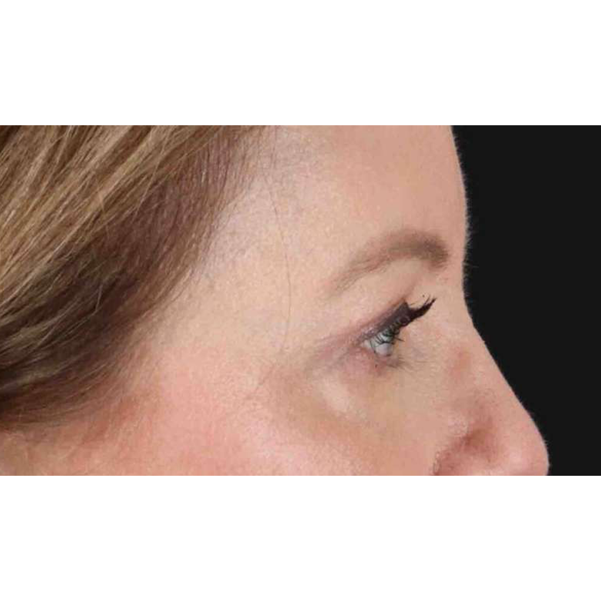Eyelid Surgery Before & After Patient #1968