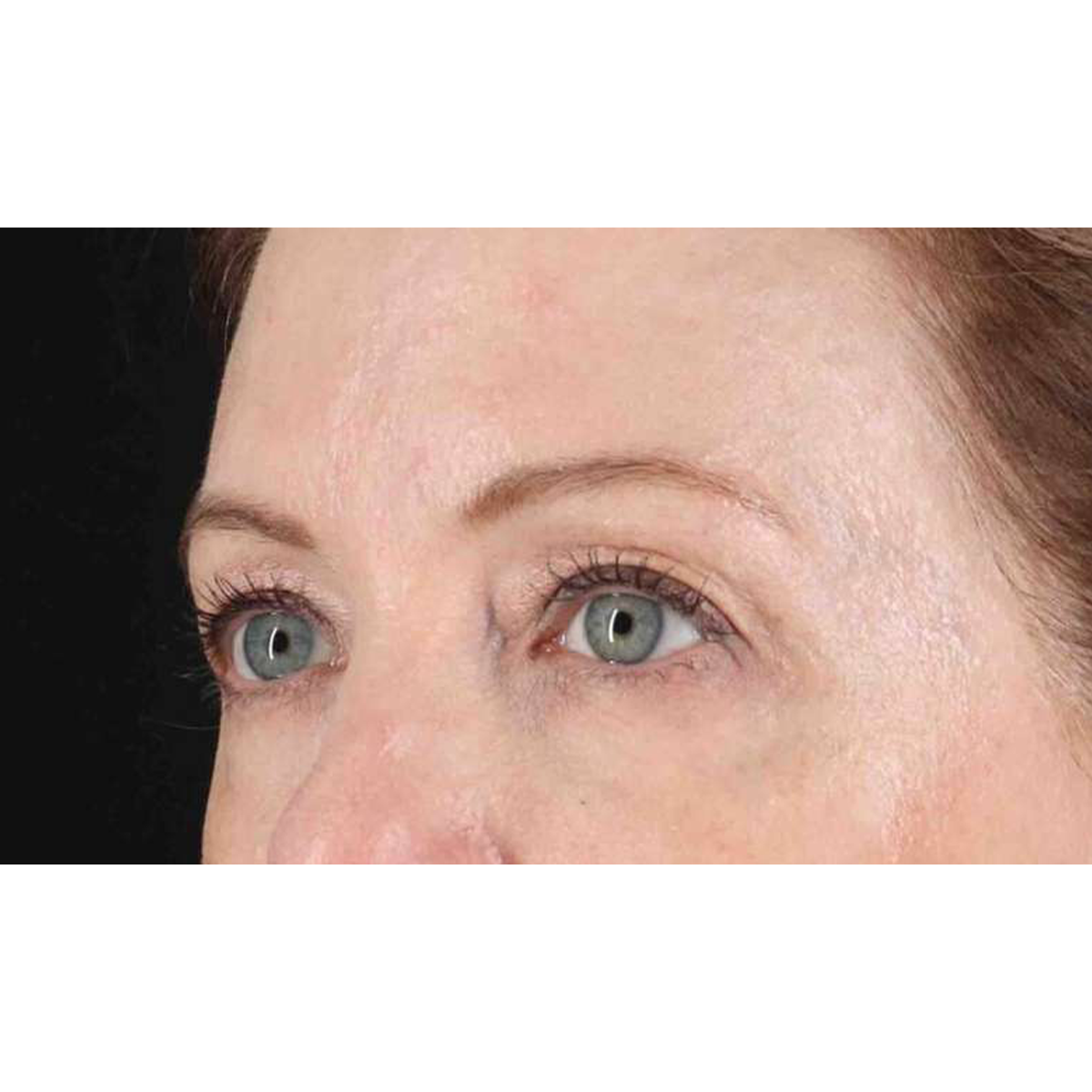 Eyelid Surgery Before & After Patient #1968