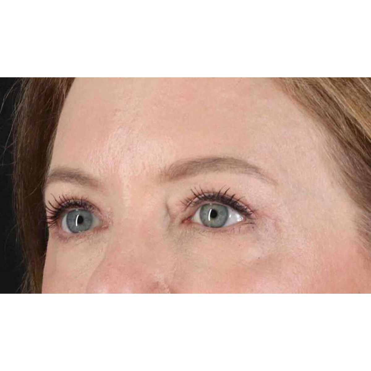 Eyelid Surgery Before & After Patient #1968